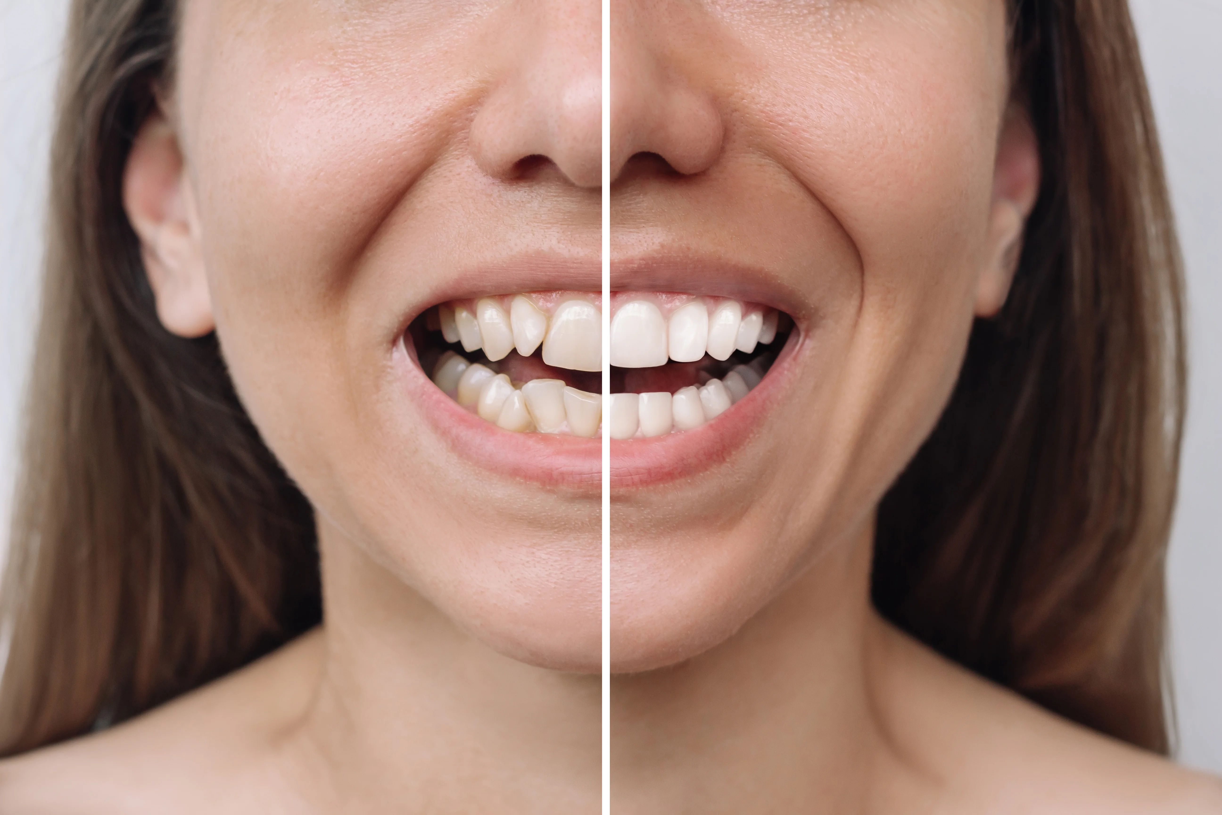 Do Your Teeth Get More Crooked as You Age?